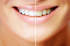 Professionelle Zahnreinigung und Bleaching: Heileingriffe unter zahnärztlichem Vorbehalt